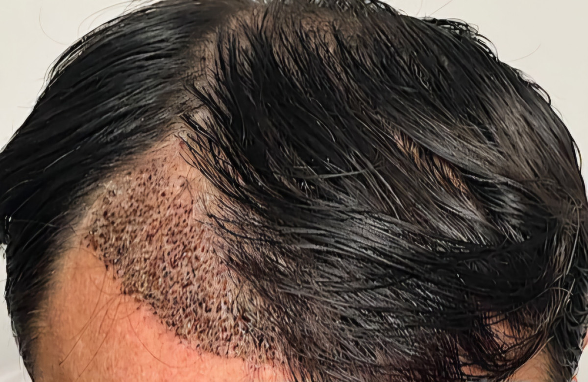 زراعة الشعر بدون حلاقة