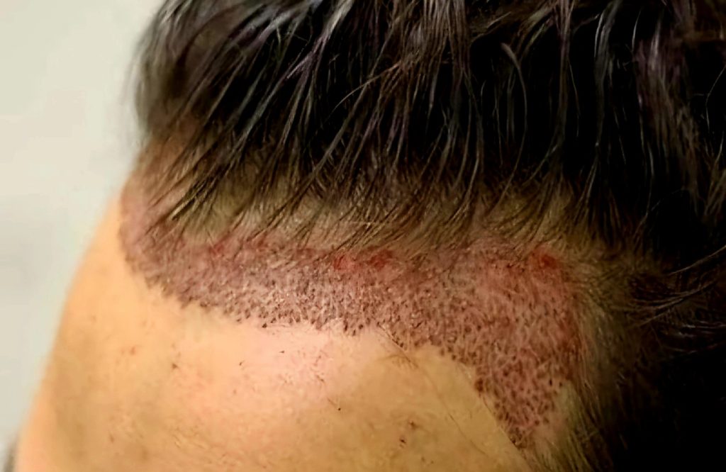 زراعة الشعر بدون حلاقة