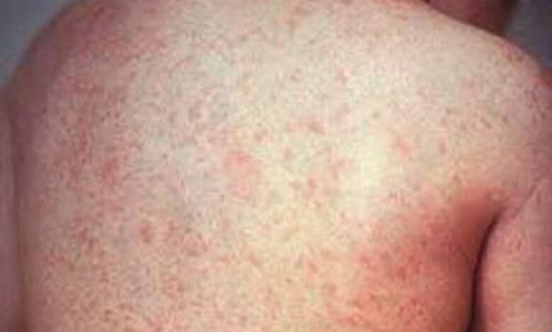 التطعيم بلقاح الحصبة